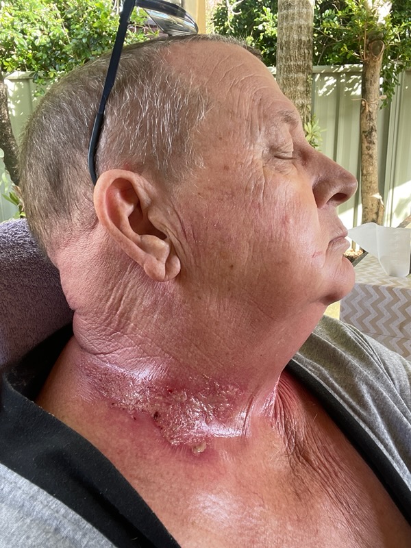 David during treatment