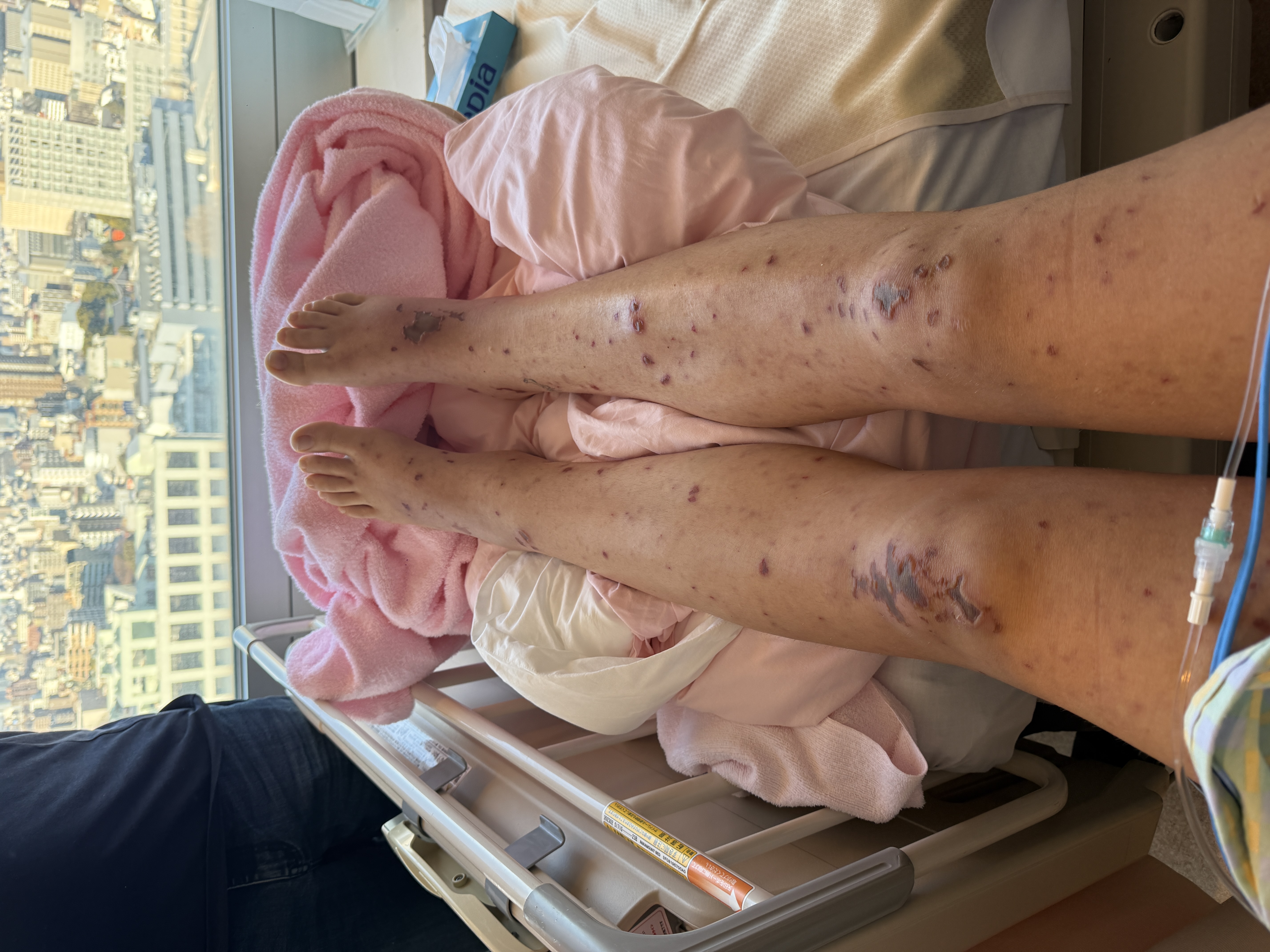 The rash led to wounds which Anna is still recovering from