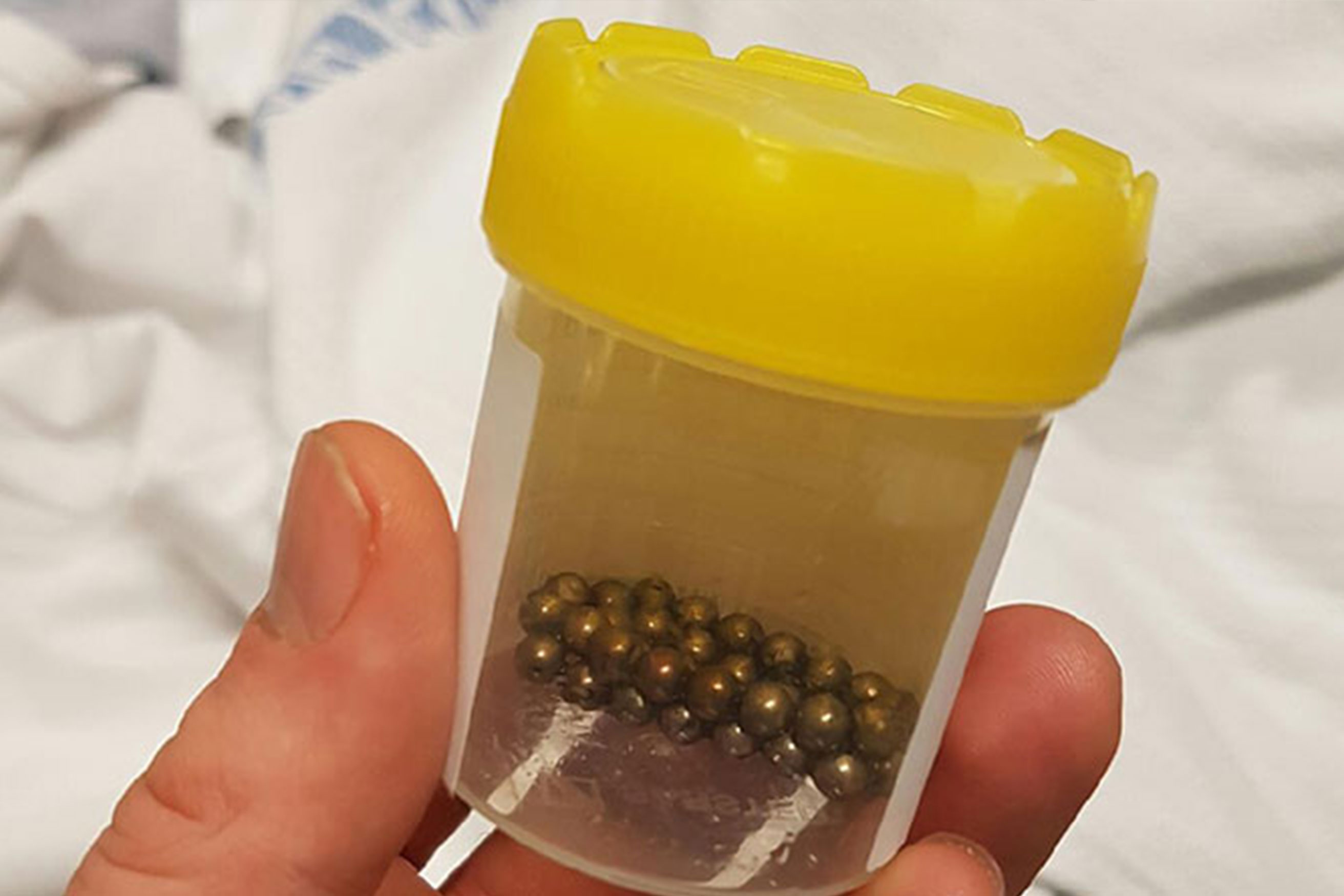 The small fridge magnets ingested by three-year-old Xander Price and removed by Gold Coast Health clinicians. The small fridge magnets ingested by three-year-old Xander Price and removed by Gold Coast Health clinicians.